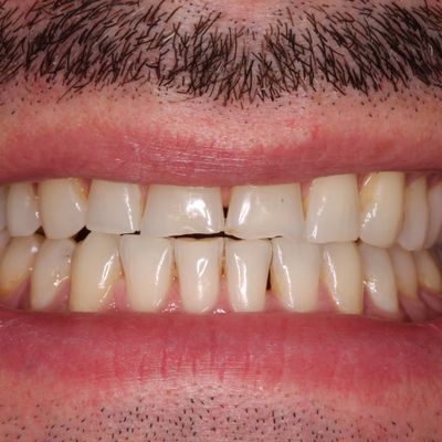 Composite Bonding - Smile 8 before